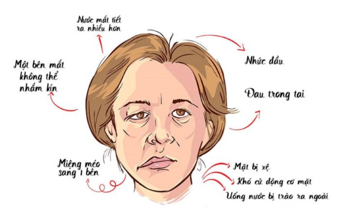 Liệt mặt nguyên phát Phần 1 - Nguyên nhân gây bệnh theo y học cổ truyền 2 liet mat nguyen phat phong kham dong y tinh tuc 2