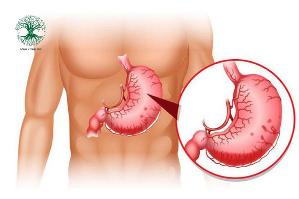 cach chua dau da day 01